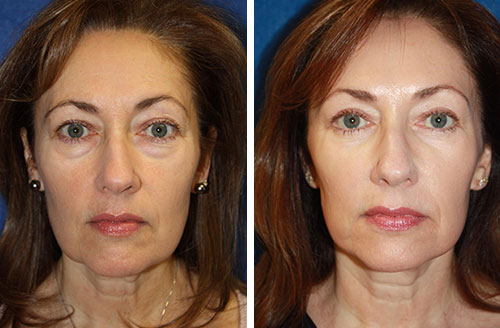 Enlarged pores improvement 2