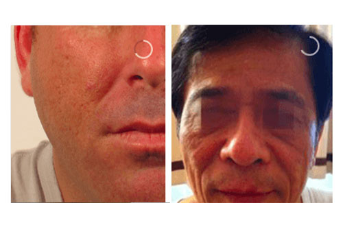 Sagging skin improvement