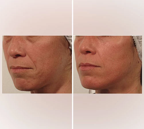 Non-Surgical Lift Programme
