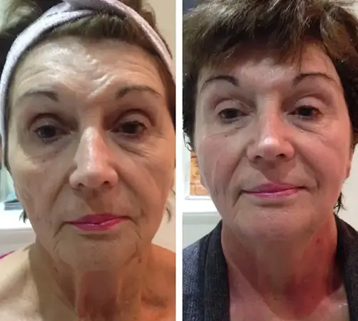 Treatment result