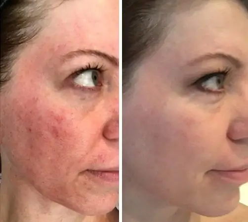 Treatment result