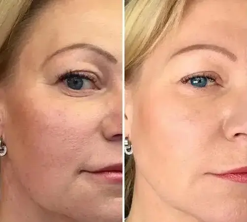 Treatment result