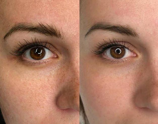 Under Eye — Before & After
