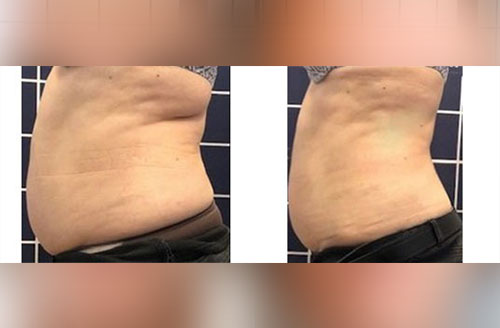 Treatment result