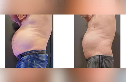 Treatment result