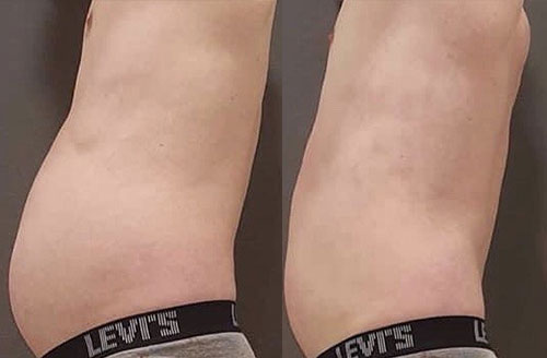 Treatment result